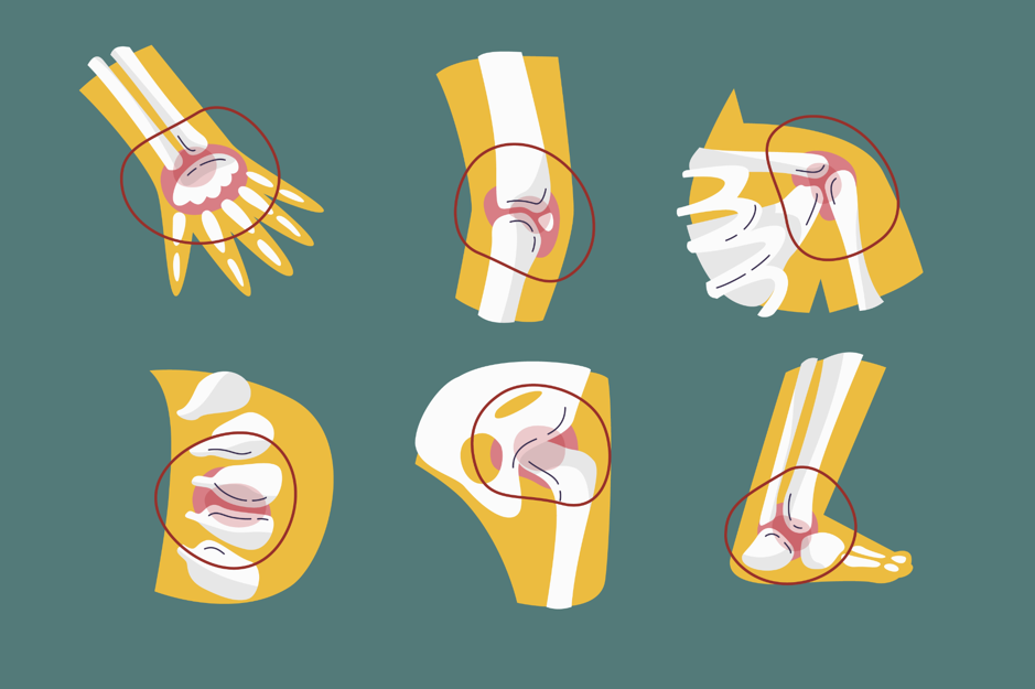 malattie degenerative articolari