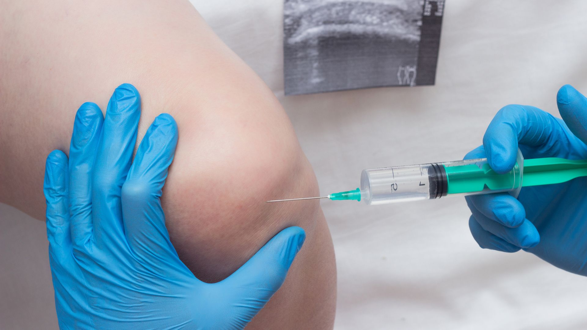 medicina rigenerativa per curare condropatia femoro-rotulea