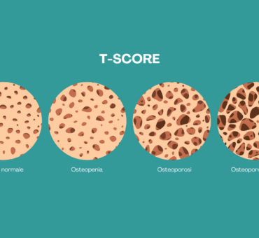 T score esame per valutare la salute dell'osso e diagnosticare il livello dell'osteoporosi