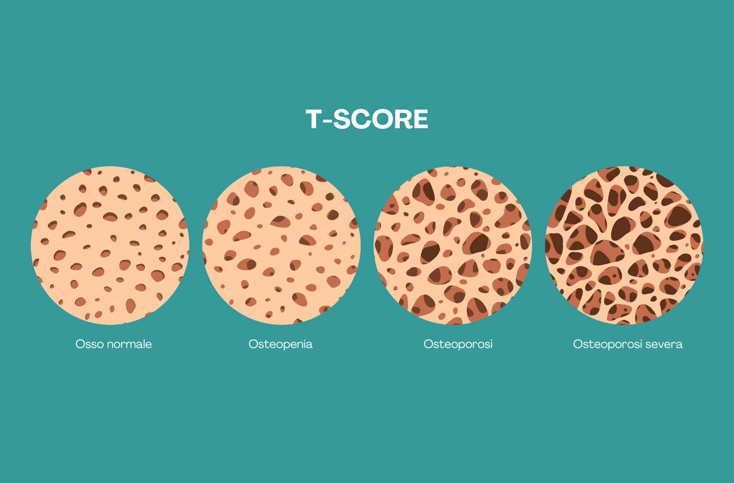 T score esame per valutare la salute dell'osso e diagnosticare il livello dell'osteoporosi